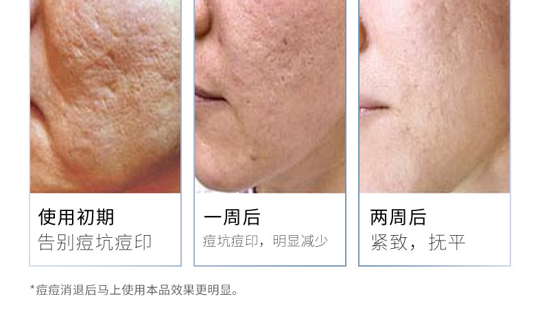 寡肽肌肤修护原液淡化痘印-广东祛痘修复精华代加工厂家